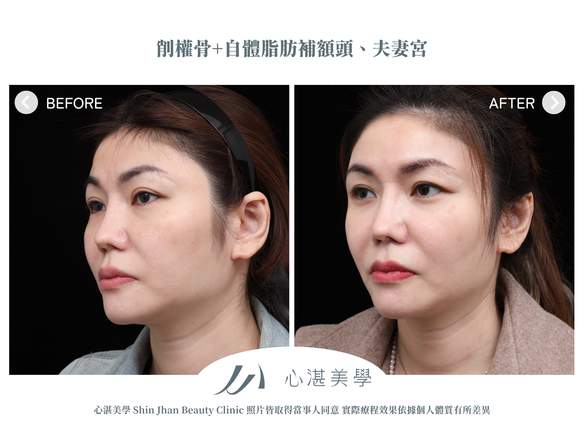 Cheekbone Reduction (1)