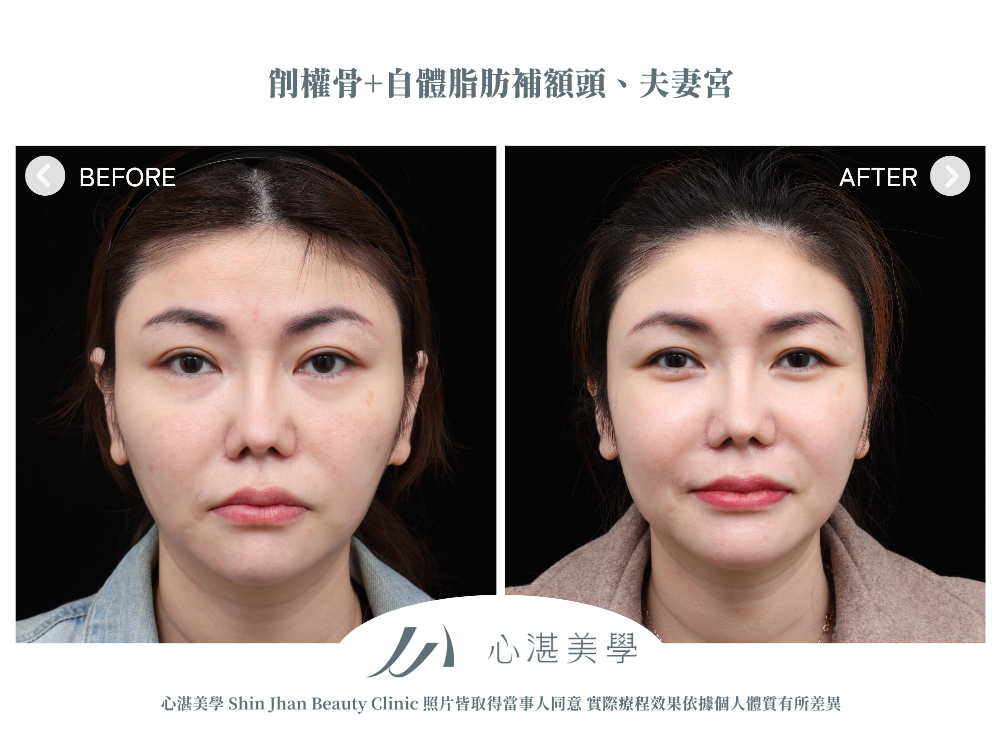 Cheekbone Reduction (2)