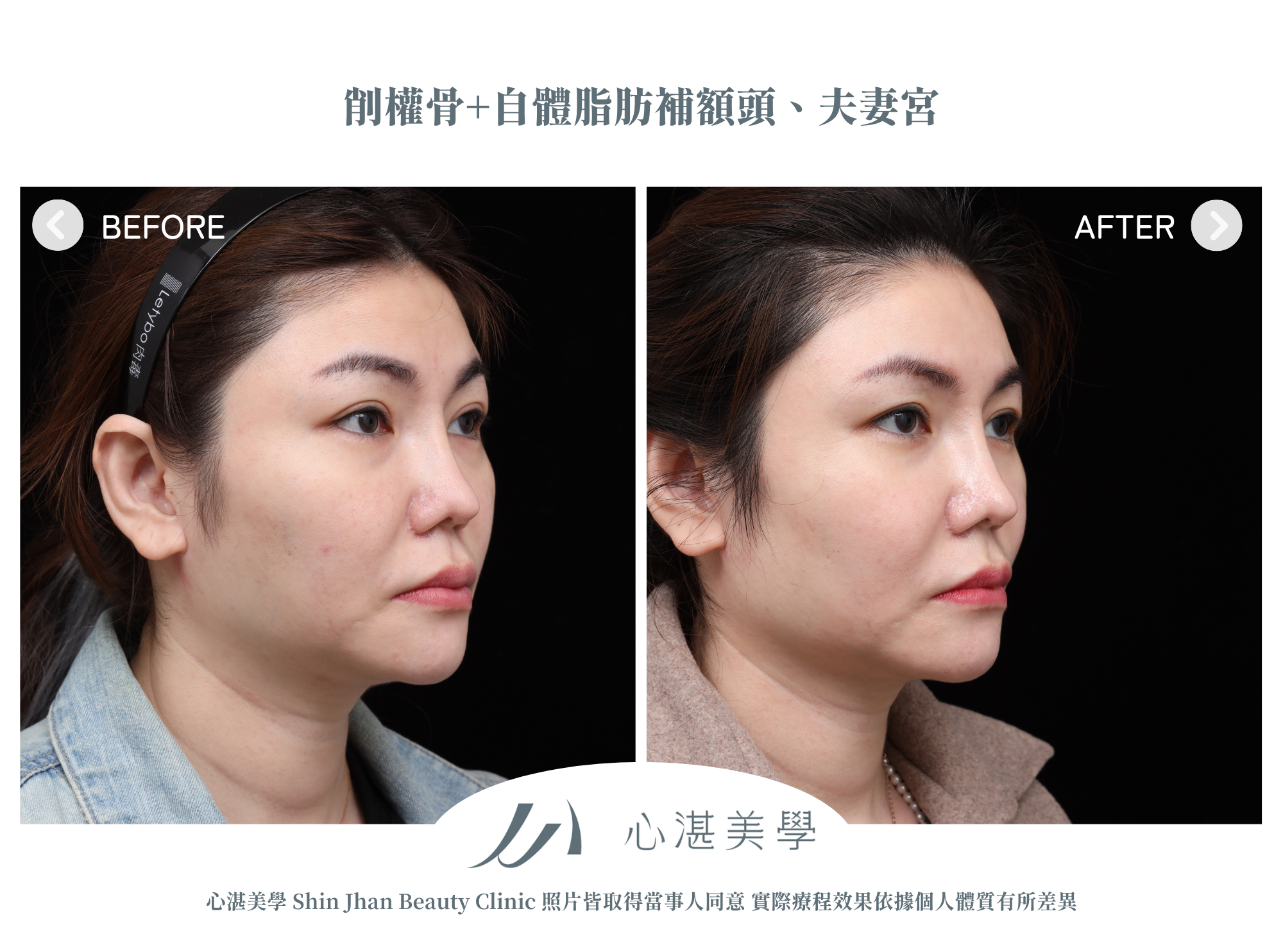 Cheekbone Reduction (3)